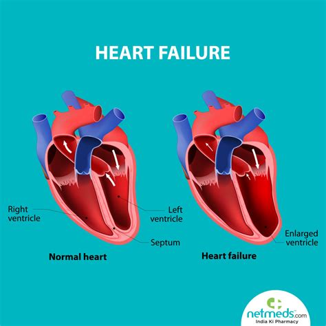 lv failure pdf|Lv dysfunction symptoms.